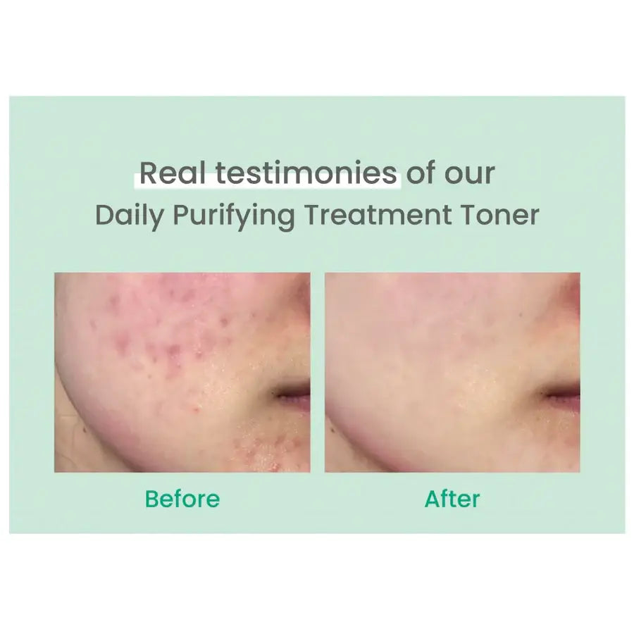 Before and after close-up of skin showing improved acne after using AXIS-Y daily purifying toner