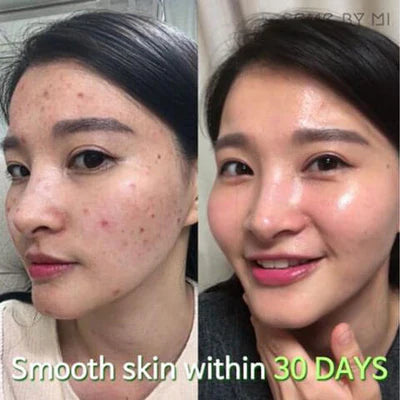 Before and after comparison showing clear skin results using Some By Mi 30 days miracle serum 50ml